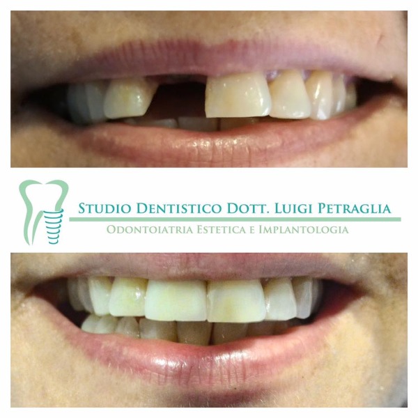 Implantologia Postestrattiva con corona in zirconio-ceramica