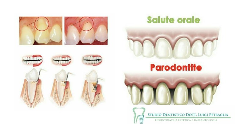 Tecniche di cura del parodonto