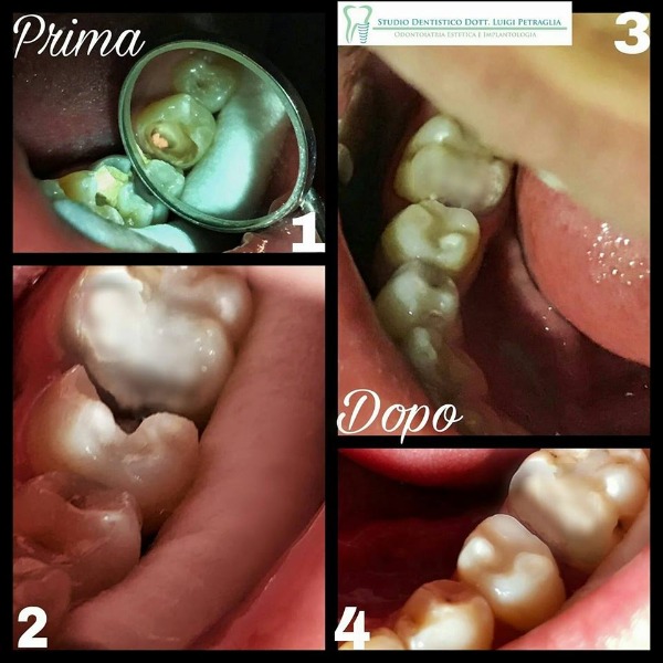 Ricostruzione di seconda classe su premolare 35 trattato endodonticamente