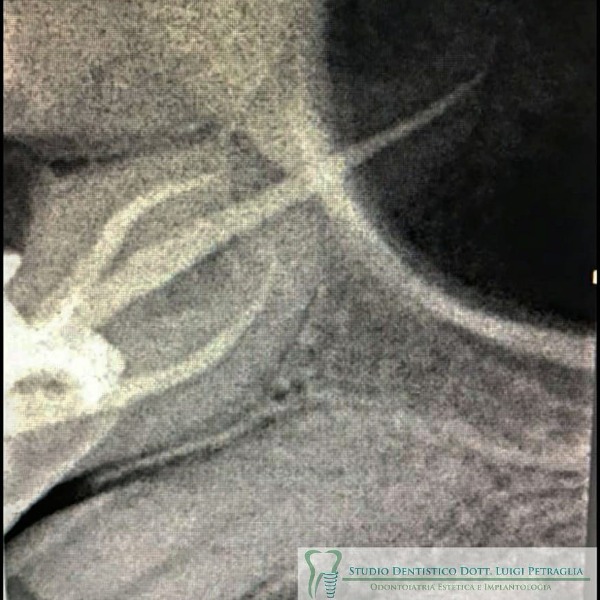 Terapia canalare di un primo molare superiore.