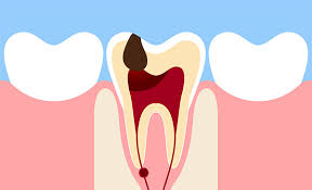 Curiamo le vostre carie nel miglior modo possibile #dentista #dental #studiodentisticopetraglia #capaccio
