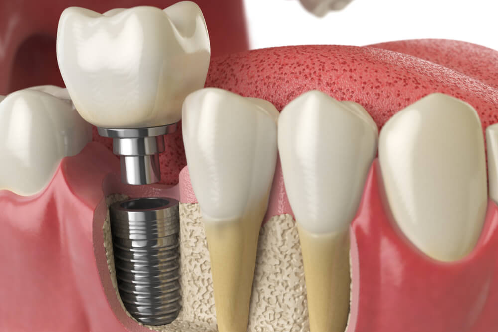 Implantologia #dentista #dental #studiodentisticopetraglia #capaccio