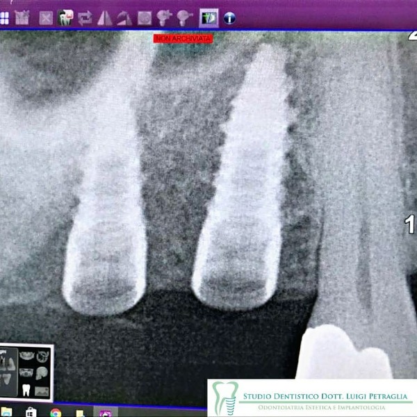 numero due impianti mascellari settore posteriore.